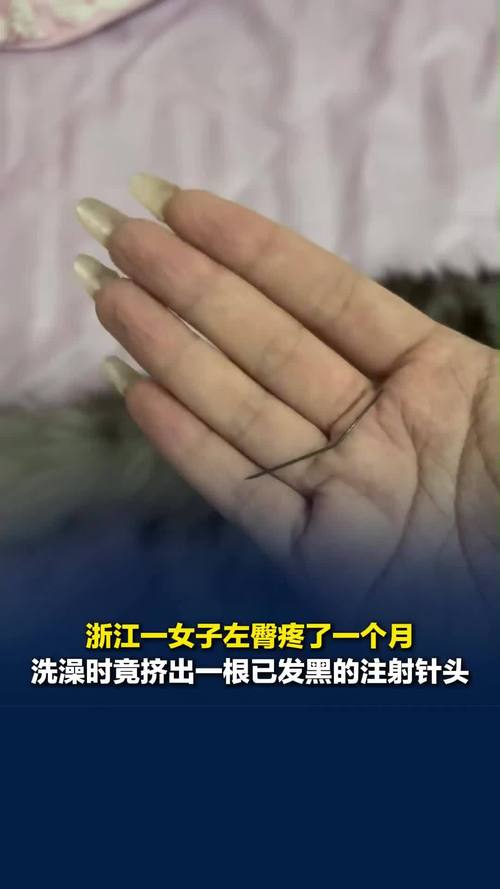 女子左臀疼一月挤出黑色注射针头