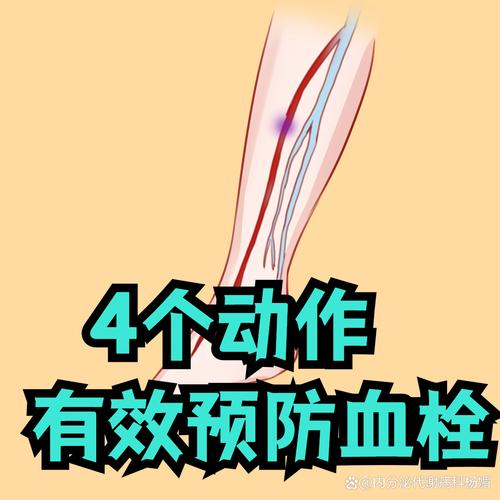 医生支招:四个日常习惯有助预防血栓