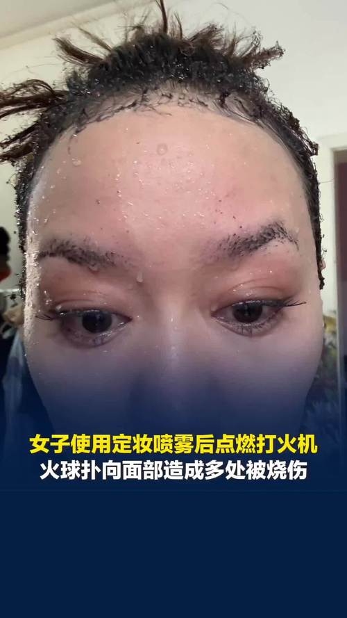 定妆喷雾遇明火瞬间起火 女子面部被火球扑中