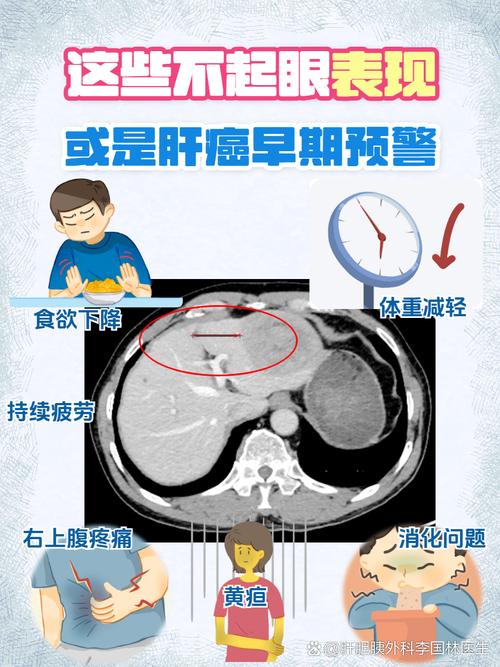 医生提醒:七成肝癌早期无明显症状