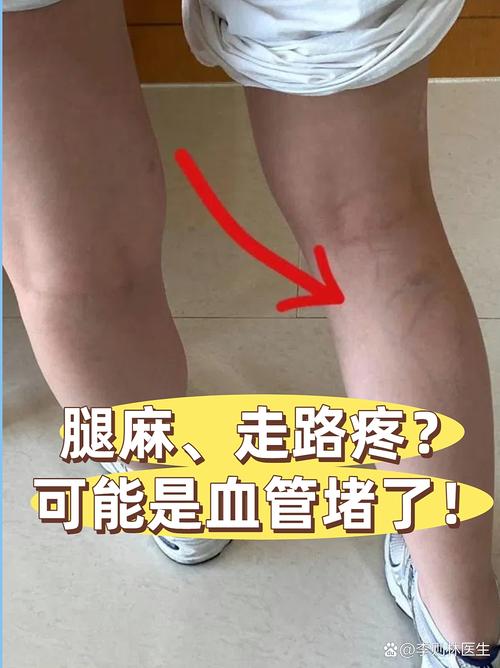 25岁小伙腹部到腿部血管几乎堵死,年轻化血管问题引关注