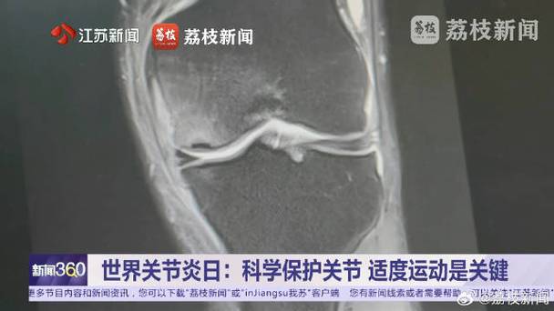 老人暴走15000步致膝部坏死,运动过量引关注